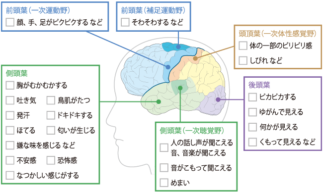 単純部分発作（焦点意識保持発作）のイラスト
